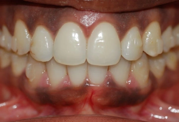 Invisalign treated case study 01 – Dentist Wandsworth