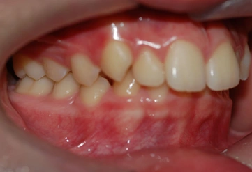 Invisalign treated case study 02 – Dentist Wandsworth