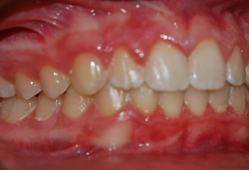 Invisalign treated case study 03 – Dentist Wandsworth