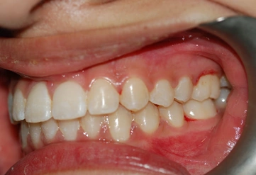 Invisalign treated case study 04 – Dentist Wandsworth