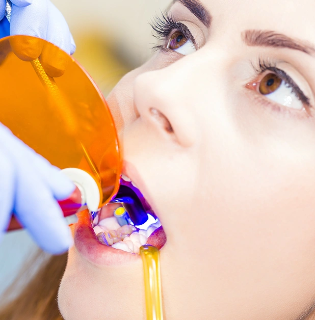 Composite Bonding at Wandsworth - Infographic By Dentist Wandsworth