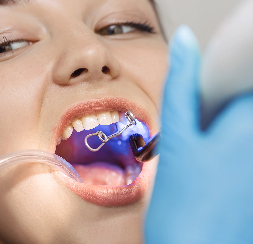 Cosmetic Bonding Procedure Explained - Dentist Wandsworth