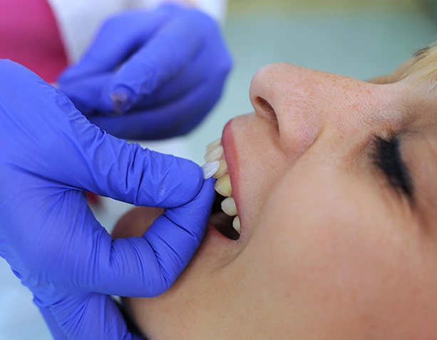 Composite Veneers at Dentist Wandsworth