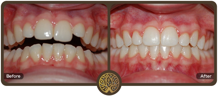 Before after image 01 – Dentist Wandsworth