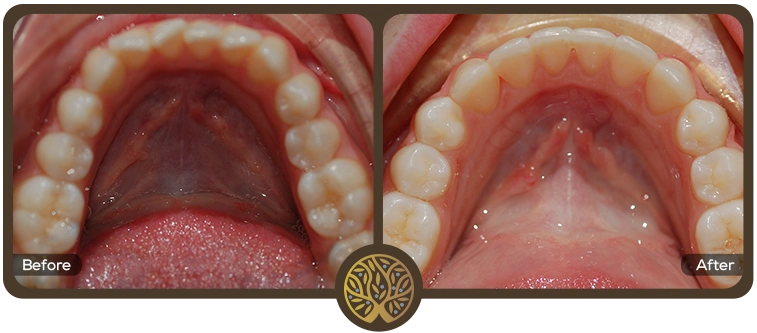 Before after image 02 – Dentist Wandsworth