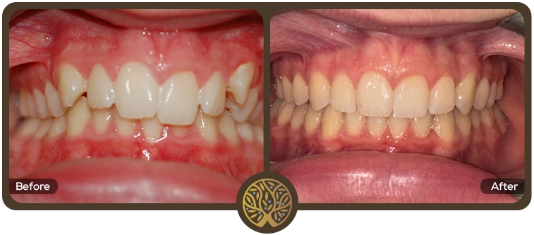 Before after image 03 – Dentist Wandsworth