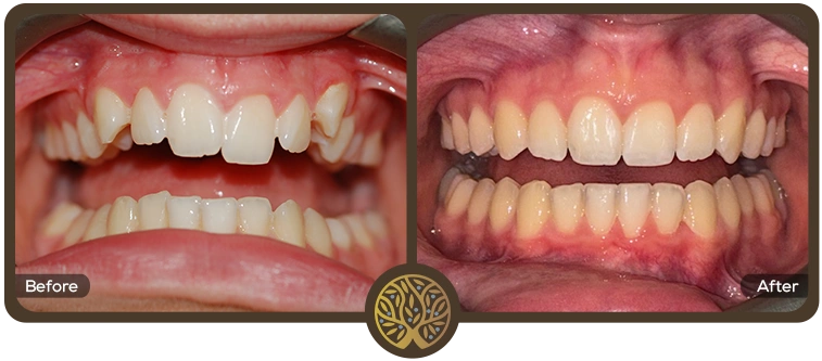 Before after image 04 – Dentist Wandsworth
