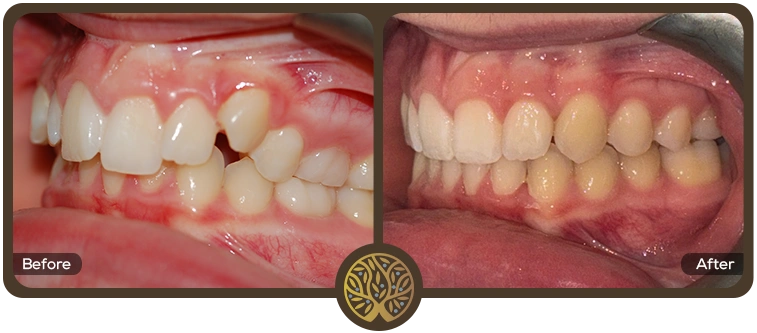 Before after image 05 – Dentist Wandsworth
