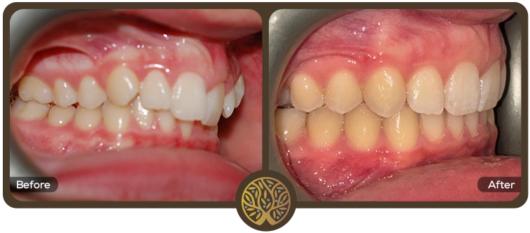 Before after image 06 – Dentist Wandsworth