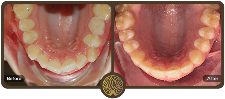 Before after image 07 – Dentist Wandsworth