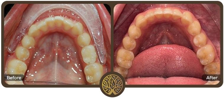 Before after image 08 – Dentist Wandsworth