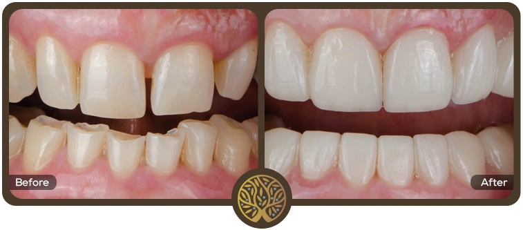 Before after image 09 – Dentist Wandsworth