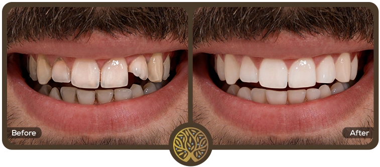 Before after image 10 – Dentist Wandsworth