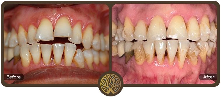 Before after image 11 – Dentist Wandsworth