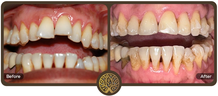 Before after image 12 – Dentist Wandsworth