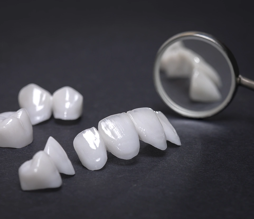 Versatile Uses of Composite Veneers Explained – Dentist Wandsworth