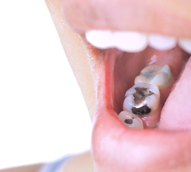 Loose Dental Filling treatment appointment at Dentist Wandsworth