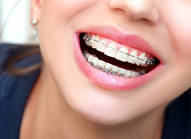 Step-by-Step Braces and Teeth Straightening at Dental Centre, Wandsworth